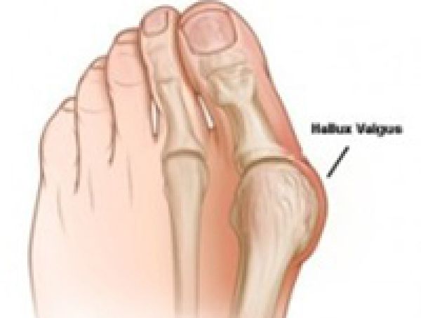 Hallux Valgus