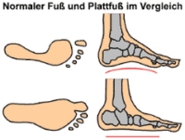 Plattfuss