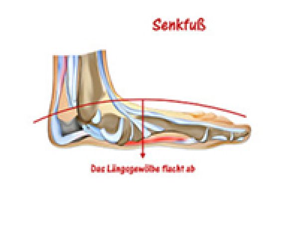 Senkfuss